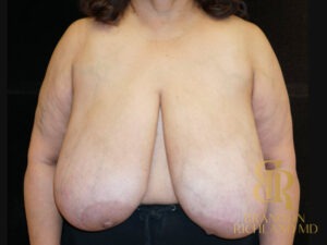 Breast Lift before and after, Patient 10 — Dr. Brandon Richland, Newport Beach