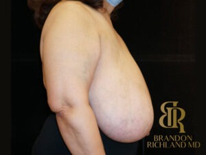 Breast Lift before and after, Patient 10 — Dr. Brandon Richland, Newport Beach
