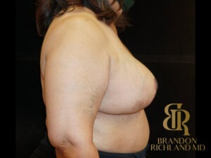 Breast Lift before and after, Patient 10 — Dr. Brandon Richland, Newport Beach