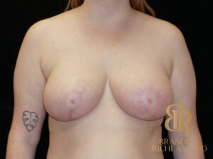 Breast Lift before and after, Patient 13 — Dr. Brandon Richland, Newport Beach