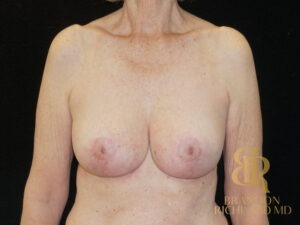 Breast Lift before and after, Patient 14 — Dr. Brandon Richland, Newport Beach