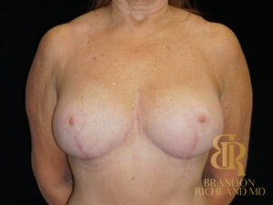 Breast Lift before and after, Patient 18 — Dr. Brandon Richland, Newport Beach
