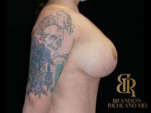 Breast Lift before and after, Patient 19 — Dr. Brandon Richland, Newport Beach