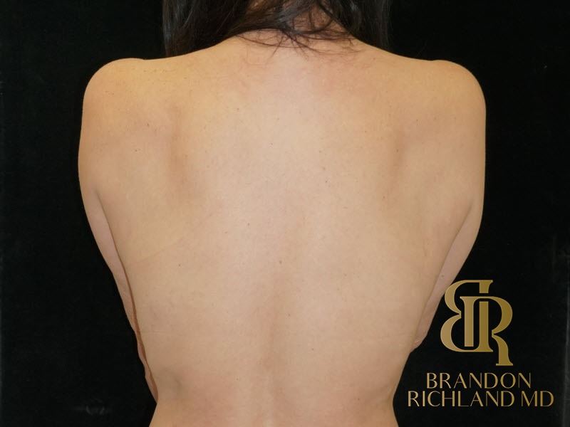 Breast Lift After, Patient 23, view 6 — Dr. Brandon Richland, Newport Beach