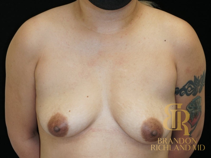 Breast Lift Before, Patient 24, view 1 — Dr. Brandon Richland, Newport Beach