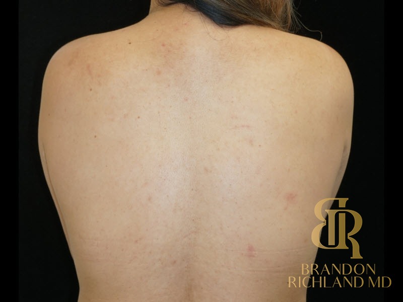 Breast Lift Before, Patient 24, view 6 — Dr. Brandon Richland, Newport Beach