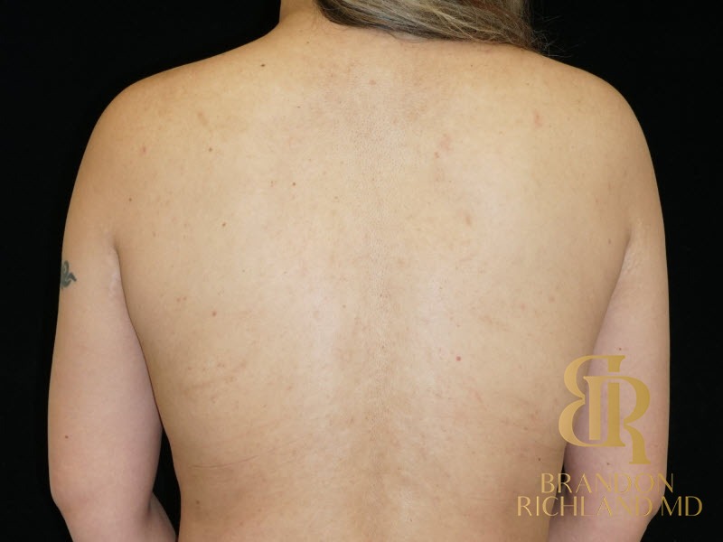 Breast Lift After, Patient 24, view 6 — Dr. Brandon Richland, Newport Beach