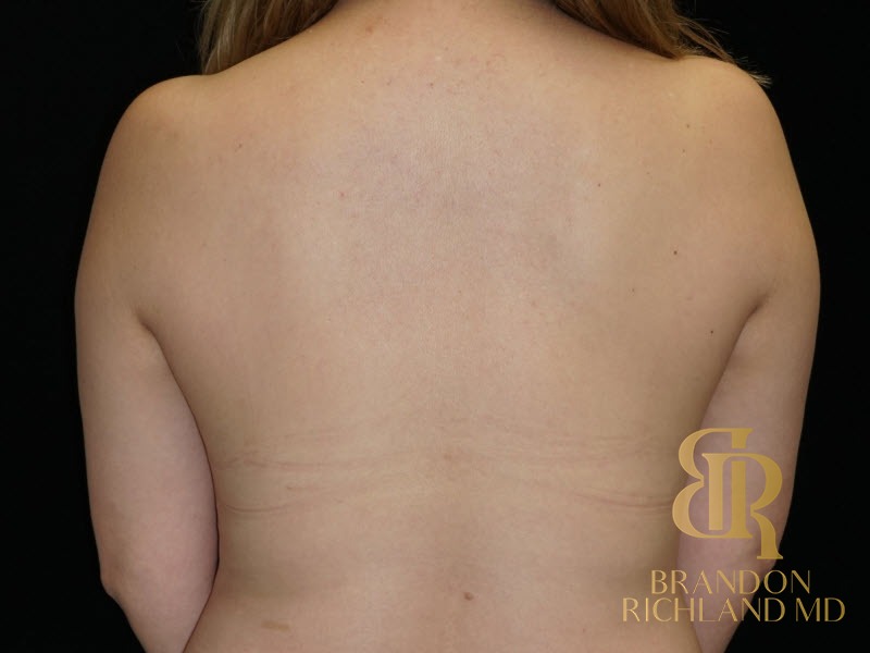 Breast Lift Before, Patient 25, view 6 — Dr. Brandon Richland, Newport Beach