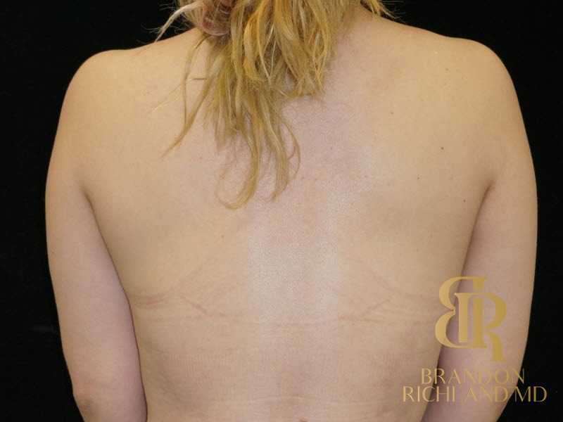 Breast Lift After, Patient 25, view 6 — Dr. Brandon Richland, Newport Beach
