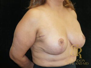 Breast Lift before and after, Patient 27 — Dr. Brandon Richland, Newport Beach