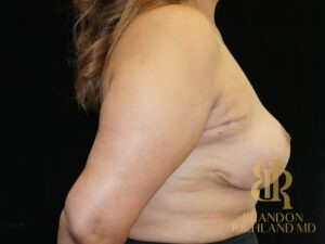 Breast Lift before and after, Patient 27 — Dr. Brandon Richland, Newport Beach
