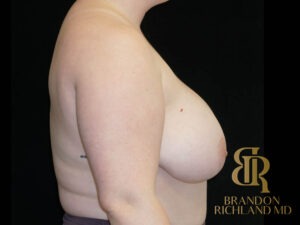 Breast Lift before and after, Patient 28 — Dr. Brandon Richland, Newport Beach