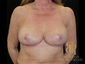 Breast Lift before and after, Patient 31 — Dr. Brandon Richland, Newport Beach