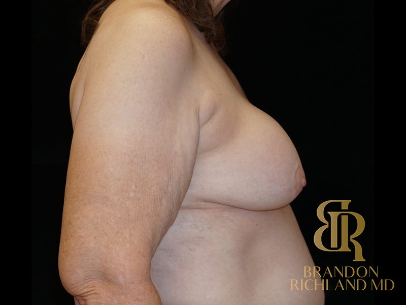 Breast Lift Before, Patient 32, view 3 — Dr. Brandon Richland, Newport Beach