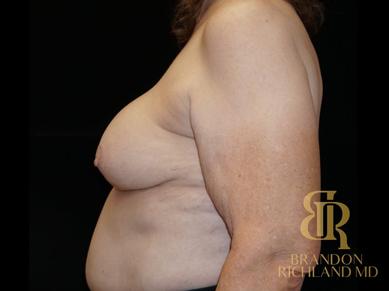 Breast Lift Before, Patient 32, view 5 — Dr. Brandon Richland, Newport Beach