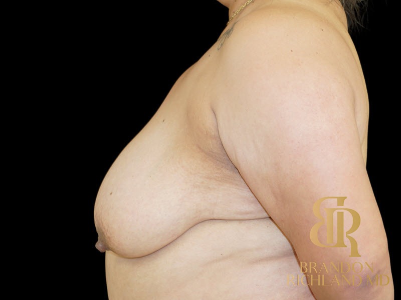 Breast Lift Before, Patient 34, view 5 — Dr. Brandon Richland, Newport Beach