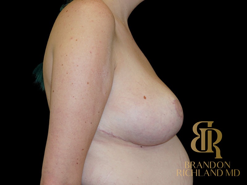 Breast Lift After, Patient 36, view 3 — Dr. Brandon Richland, Newport Beach