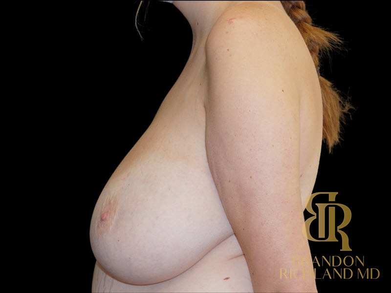 Breast Lift Before, Patient 36, view 5 — Dr. Brandon Richland, Newport Beach