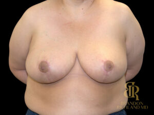 Breast Reduction before and after, Case #38906 — Dr. Brandon Richland, Newport Beach