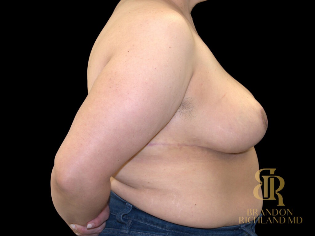 Breast Lift After, Case #38906, view 3 — Dr. Brandon Richland, Newport Beach