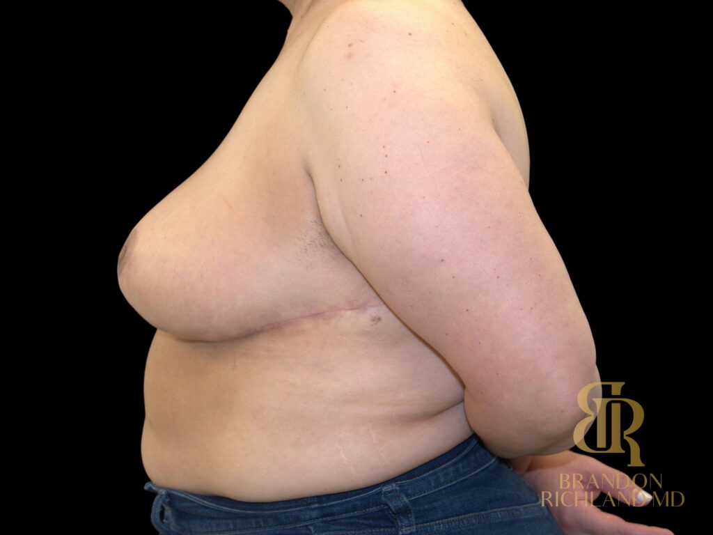 Breast Lift After, Case #38906, view 5 — Dr. Brandon Richland, Newport Beach