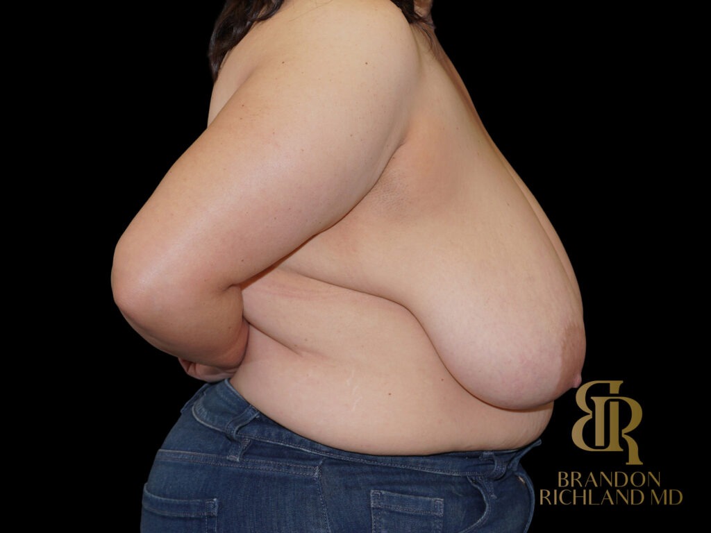 Breast Lift Before, Case #38906, view 3 — Dr. Brandon Richland, Newport Beach