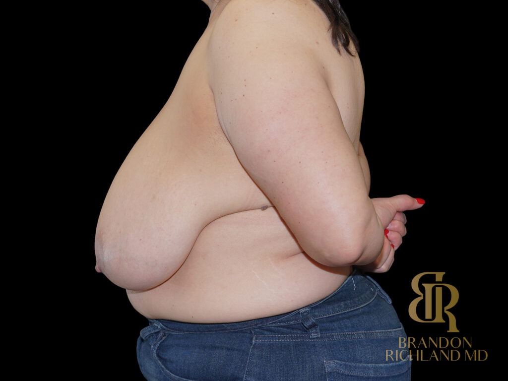 Breast Lift Before, Case #38906, view 5 — Dr. Brandon Richland, Newport Beach