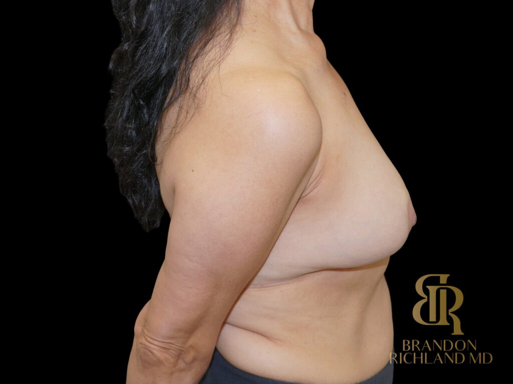 Breast Revision After, Case #51534, view 3 — Dr. Brandon Richland, Newport Beach