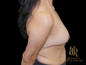 Breast Revision before and after, Case #51534 — Dr. Brandon Richland, Newport Beach
