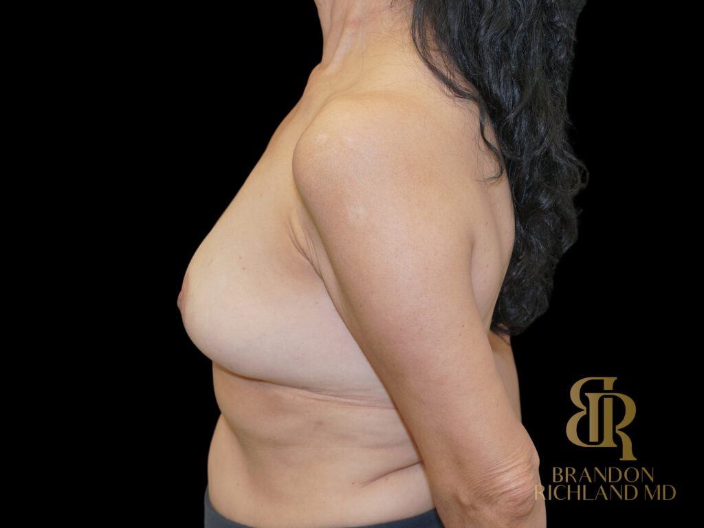 Breast Revision After, Case #51534, view 5 — Dr. Brandon Richland, Newport Beach
