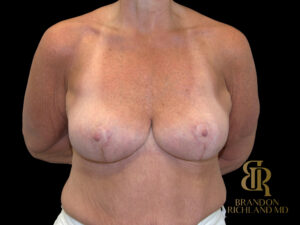 Breast Reduction before and after, Case #53240 — Dr. Brandon Richland, Newport Beach