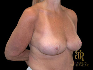 Breast Reduction before and after, Case #53240 — Dr. Brandon Richland, Newport Beach