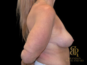 Breast Reduction before and after, Case #53240 — Dr. Brandon Richland, Newport Beach