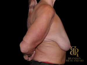 Breast Reduction before and after, Case #53240 — Dr. Brandon Richland, Newport Beach