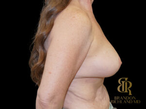 Liposuction before and after, Case #95207 — Dr. Brandon Richland, Newport Beach