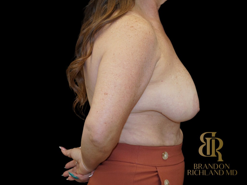 Breast Lift Before, Case #95207, view 3 — Dr. Brandon Richland, Newport Beach