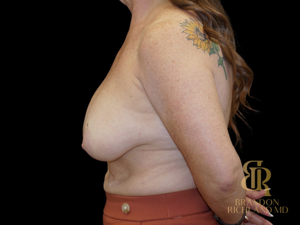 Breast Lift Before, Case #95207, view 5 — Dr. Brandon Richland, Newport Beach