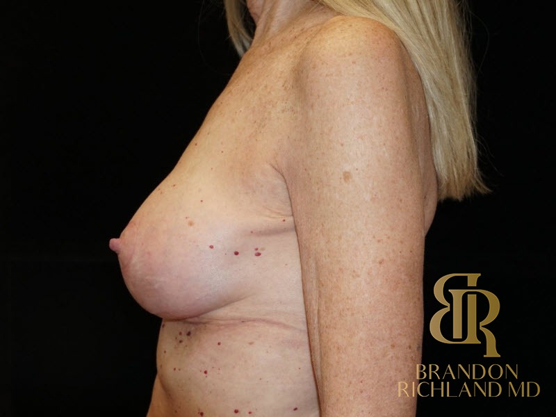 Breast Reconstruction After photo, Patient 02