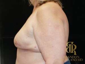 Breast Reconstruction before and after, Patient 05 — Dr. Brandon Richland, Newport Beach