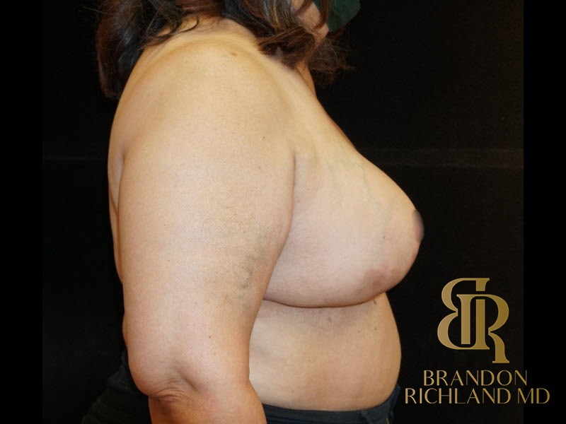 Breast Reduction After, Patient 05, view 3 — Dr. Brandon Richland, Newport Beach