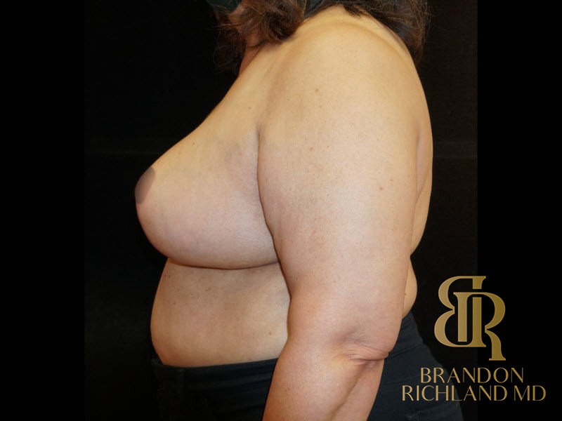 Breast Reduction After, Patient 05, view 5 — Dr. Brandon Richland, Newport Beach