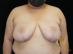 Breast Reduction before and after, Patient 09 — Dr. Brandon Richland, Newport Beach