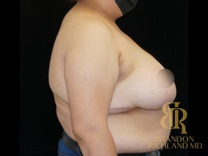 Breast Reduction before and after, Patient 09 — Dr. Brandon Richland, Newport Beach