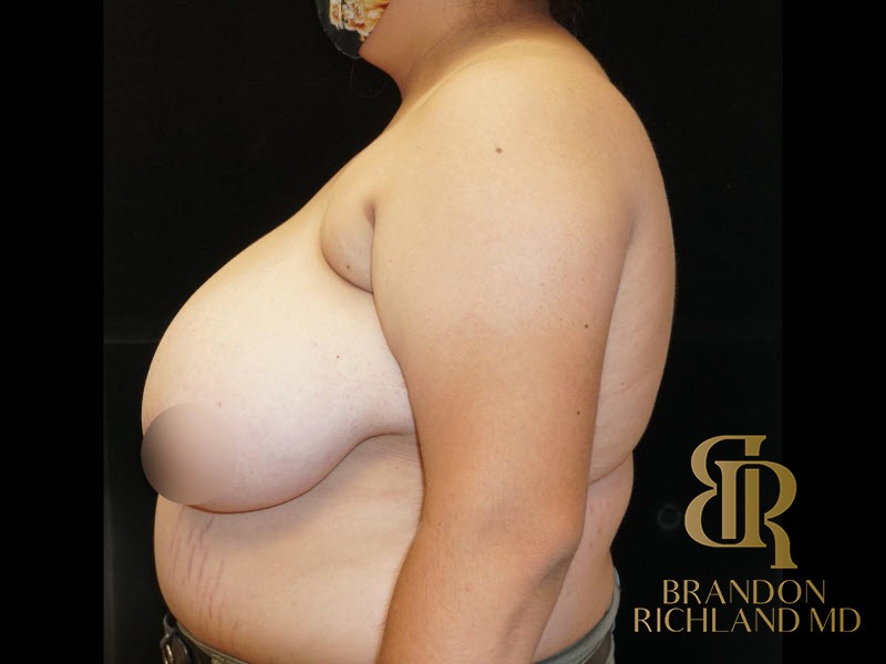 Breast Reduction Before, Patient 09, view 5 — Dr. Brandon Richland, Newport Beach