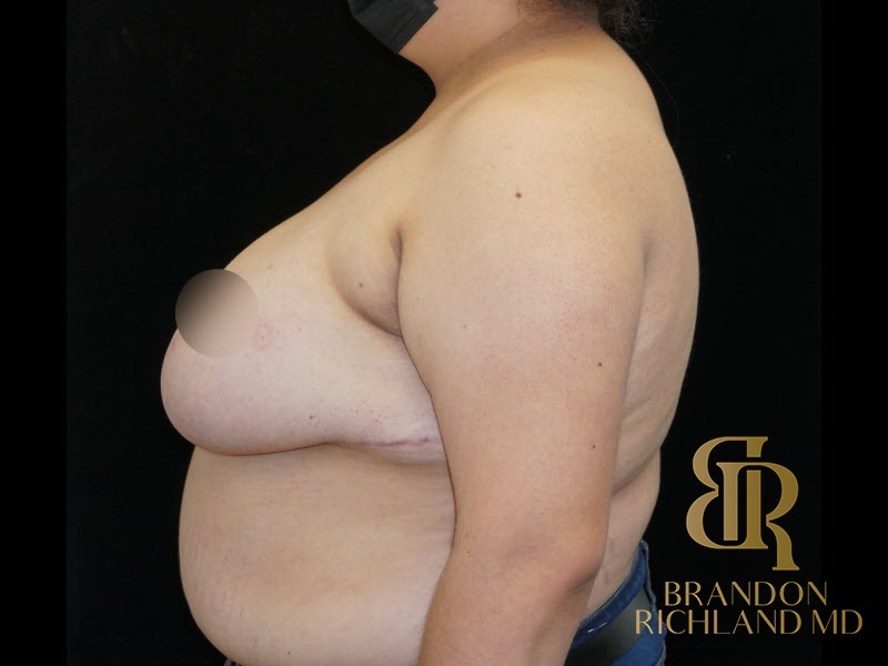Breast Reduction After, Patient 09, view 5 — Dr. Brandon Richland, Newport Beach