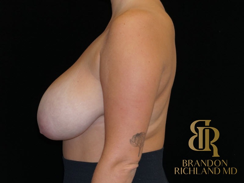 Breast Reduction Before, Patient 13, view 5 — Dr. Brandon Richland, Newport Beach