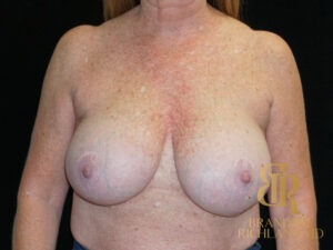 Breast Reduction before and after, Patient 14 — Dr. Brandon Richland, Newport Beach