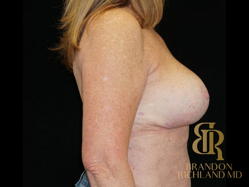 Breast Reduction After, Patient 14, view 3 — Dr. Brandon Richland, Newport Beach