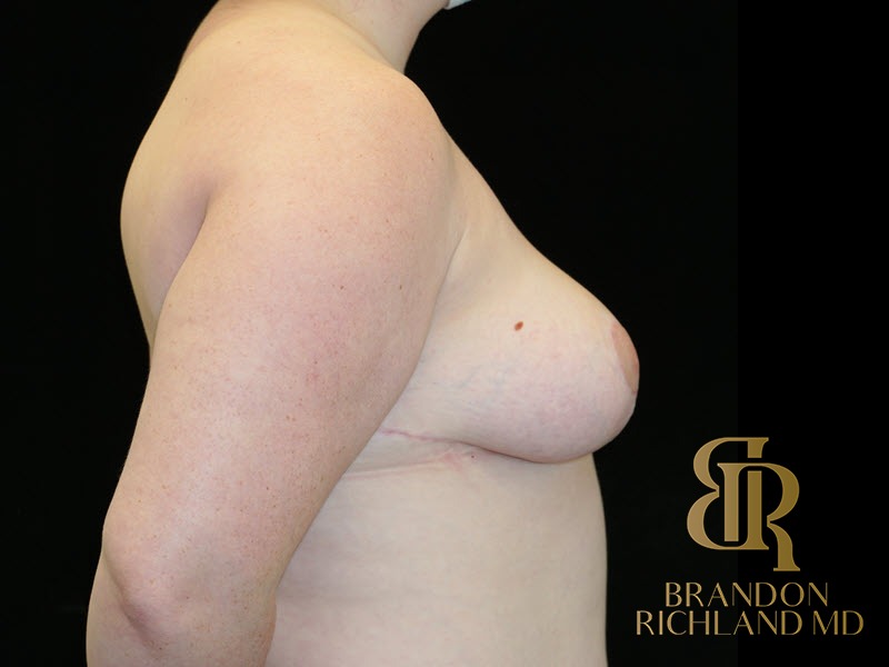 Breast Reduction After, Patient 16, view 3 — Dr. Brandon Richland, Newport Beach