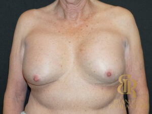 Breast Revision before and after, Patient 03 — Dr. Brandon Richland, Newport Beach
